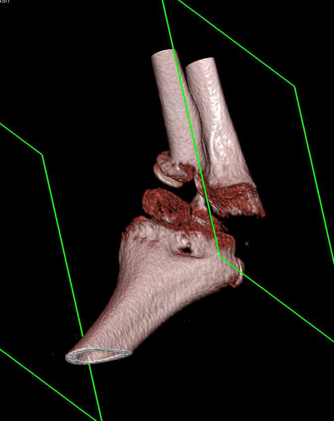 Ulna and Radius Fractures - CTisus CT Scan