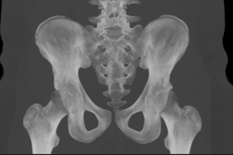 Multiple 3D Perspectives of the Pelvis - CTisus CT Scan