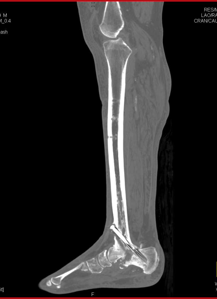 Nonunion Tibial Fracture - CTisus CT Scan