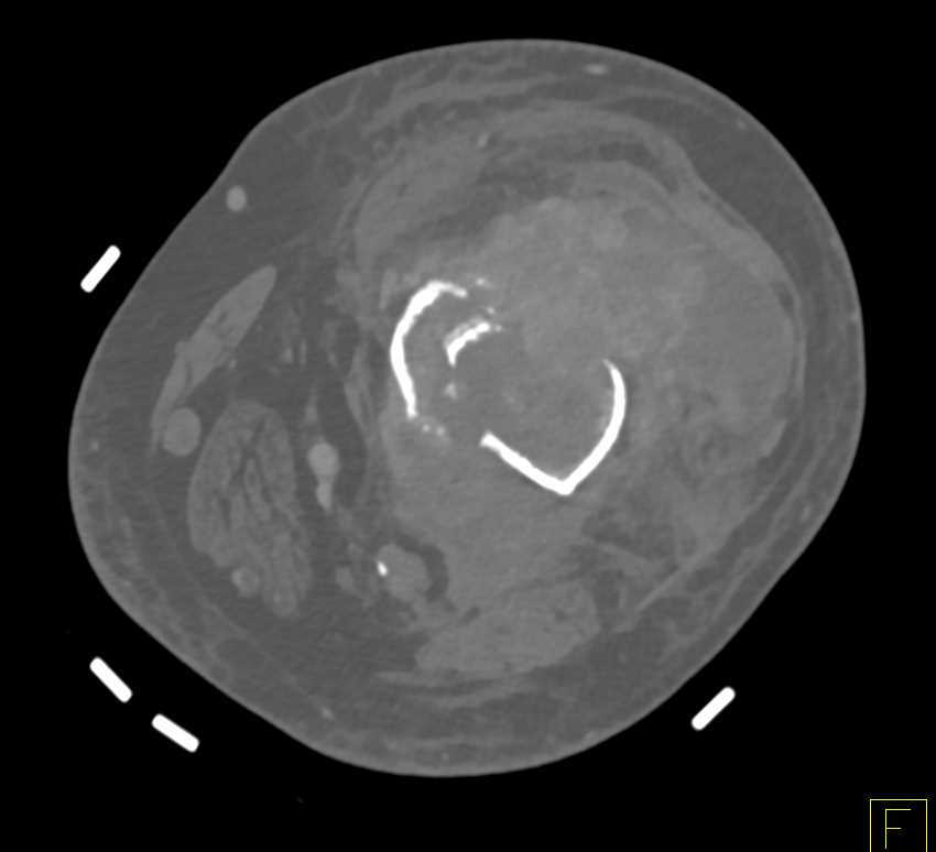 Distal Femur Fracture with Hematoma - CTisus CT Scan