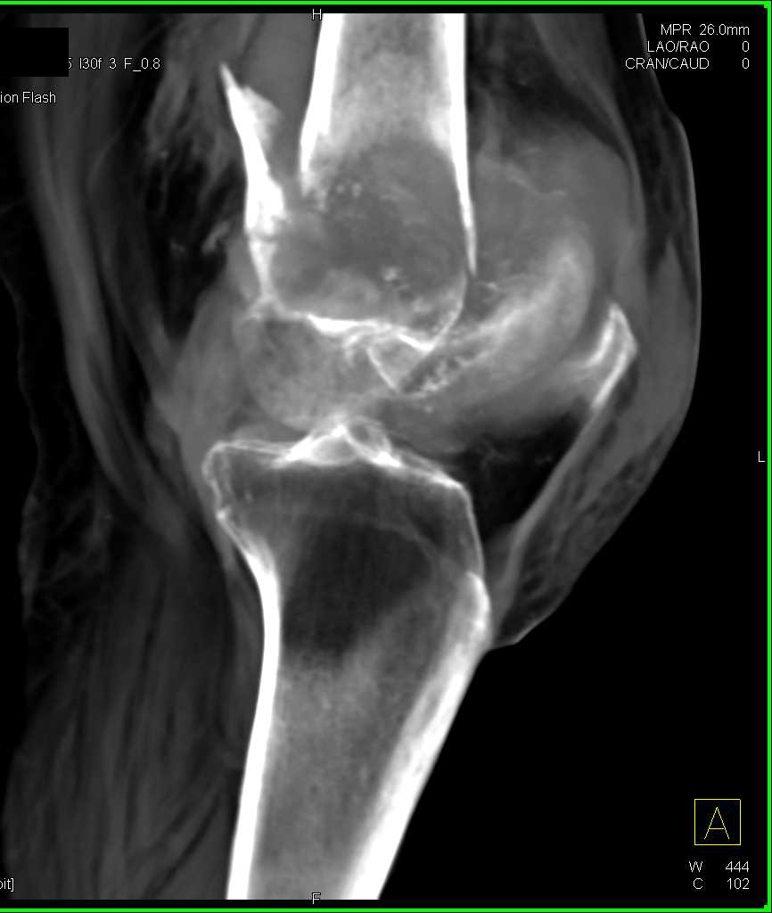 Distal Femur Fracture With Hematoma Musculoskeletal Case Studies