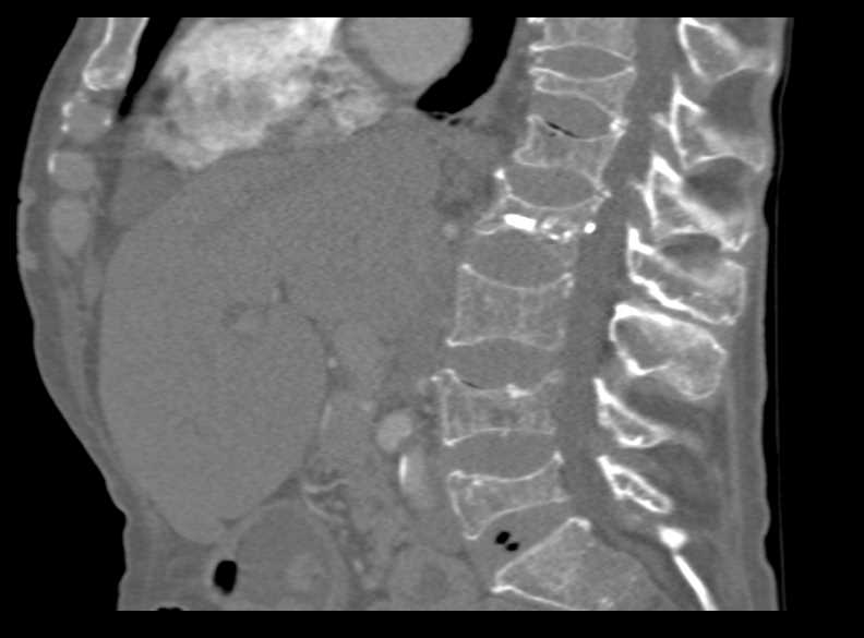 Osteoporosis Involves the Lumbar Spine - CTisus CT Scan