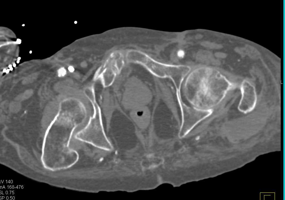 Symphysis Fracture - CTisus CT Scan