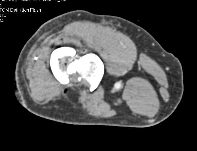 Fracture Distal Femur - CTisus CT Scan