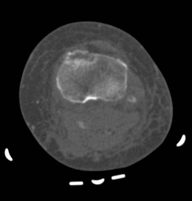 Tibial Plateau Fracture - CTisus CT Scan