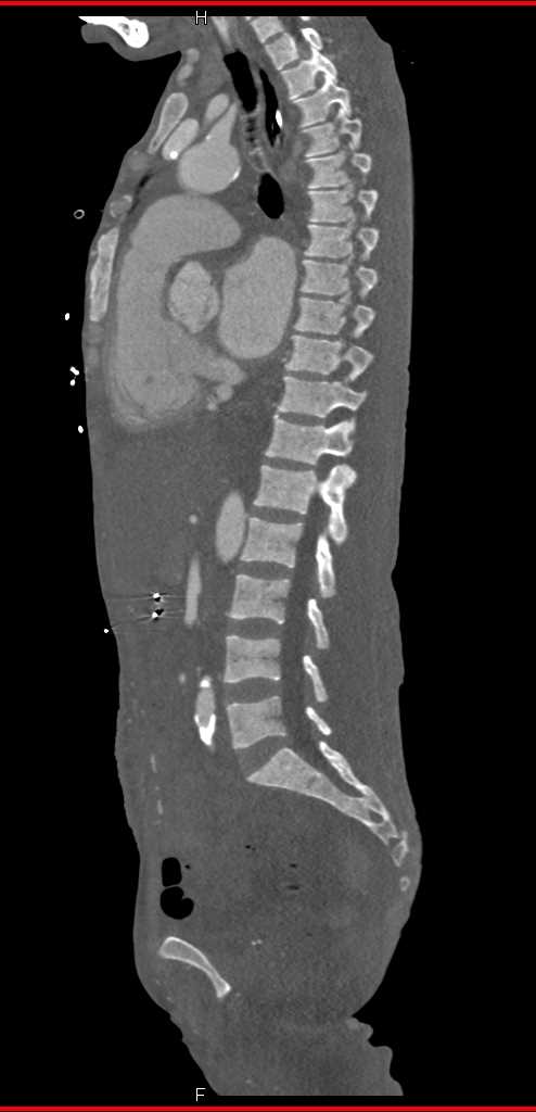 Renal Osteodystrophy Spine - CTisus CT Scan