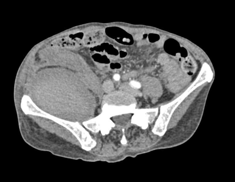 Right Iliopsoas Bleed - CTisus CT Scan