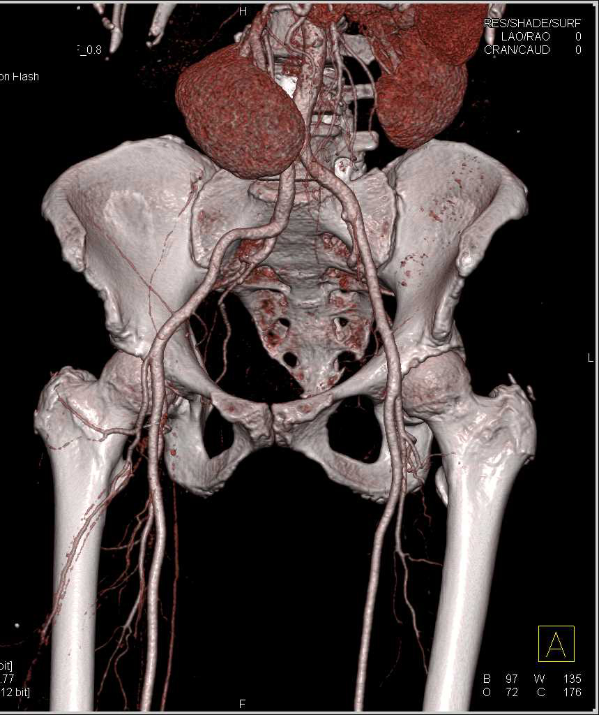 Right Iliopsoas Bleed - Musculoskeletal Case Studies - CTisus CT Scanning