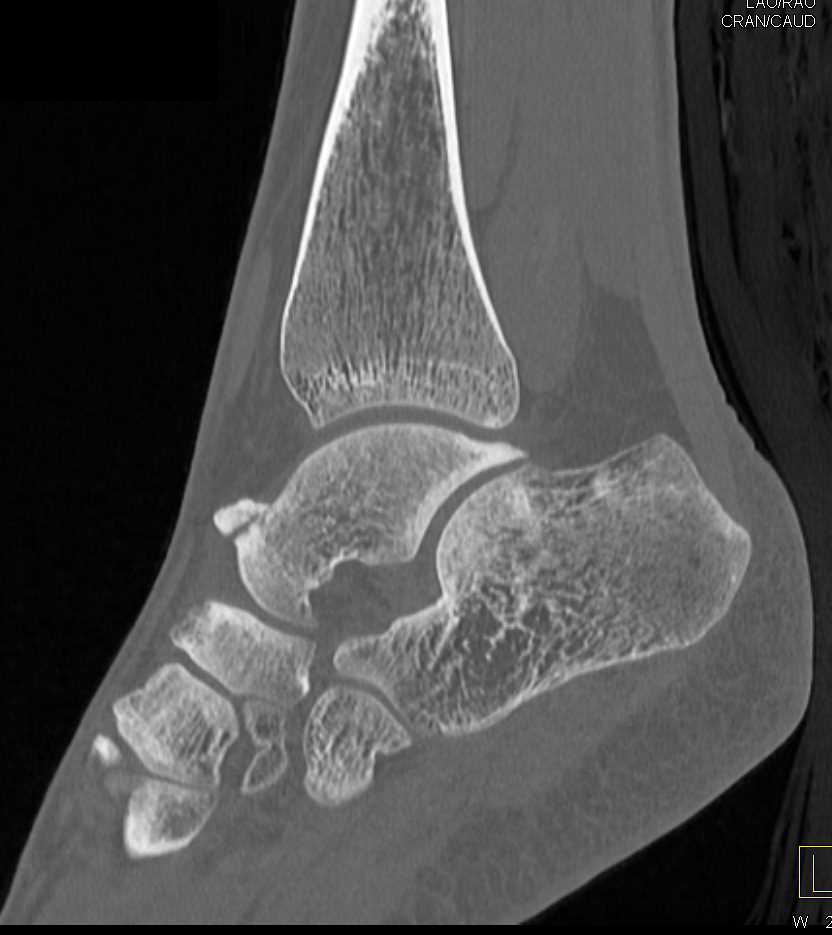 Talus Fracture - CTisus CT Scan