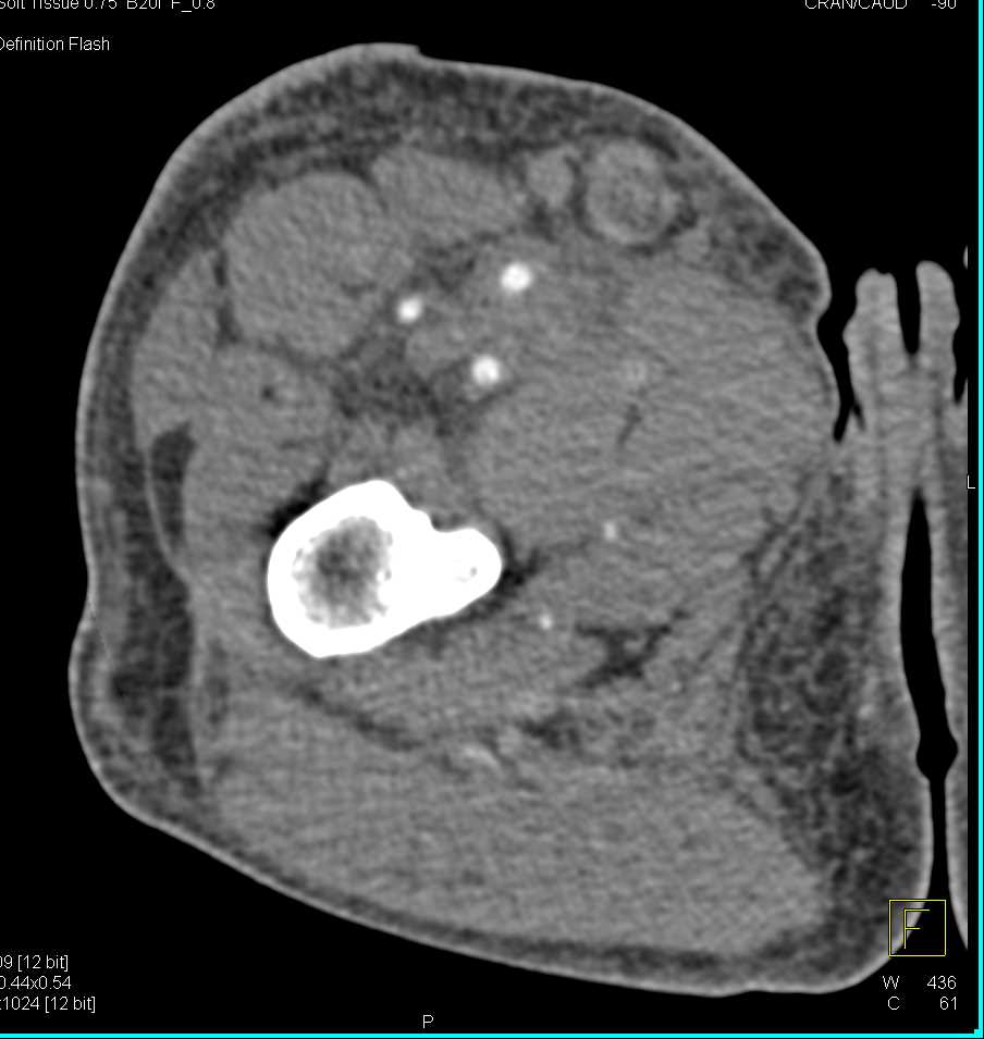 Intravenous Drug Abuse (IVDA) with Cellulitis and Adenopathy Right Groin - CTisus CT Scan