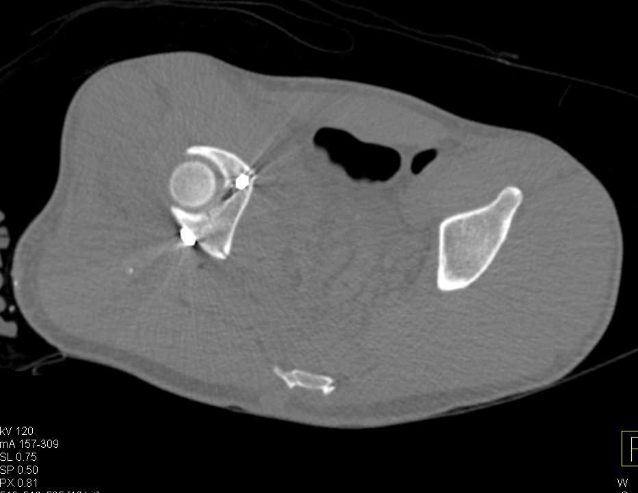 Fracture and Pinning of Acetabular Fracture - CTisus CT Scan