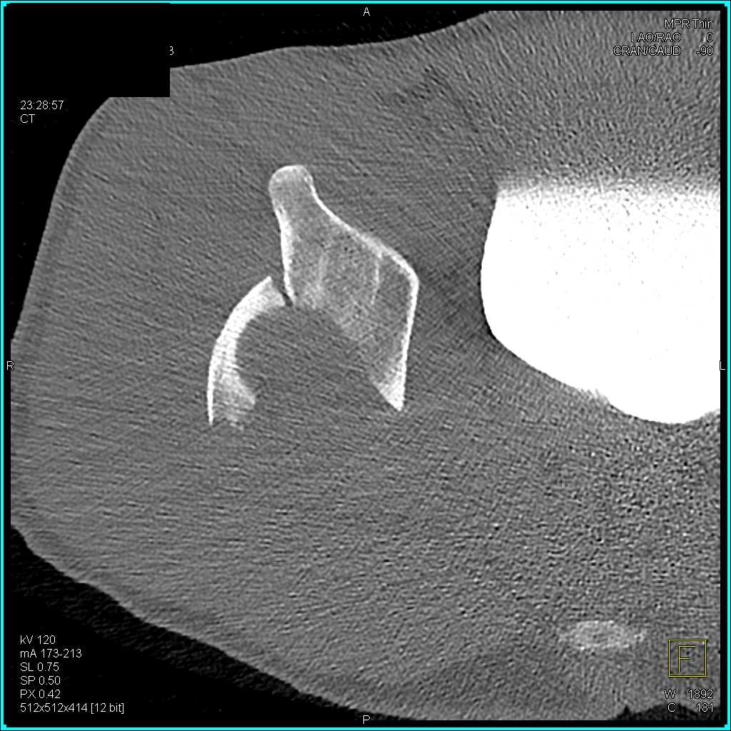 Fracture Acetabulum with Hematoma and Dislocation - CTisus CT Scan