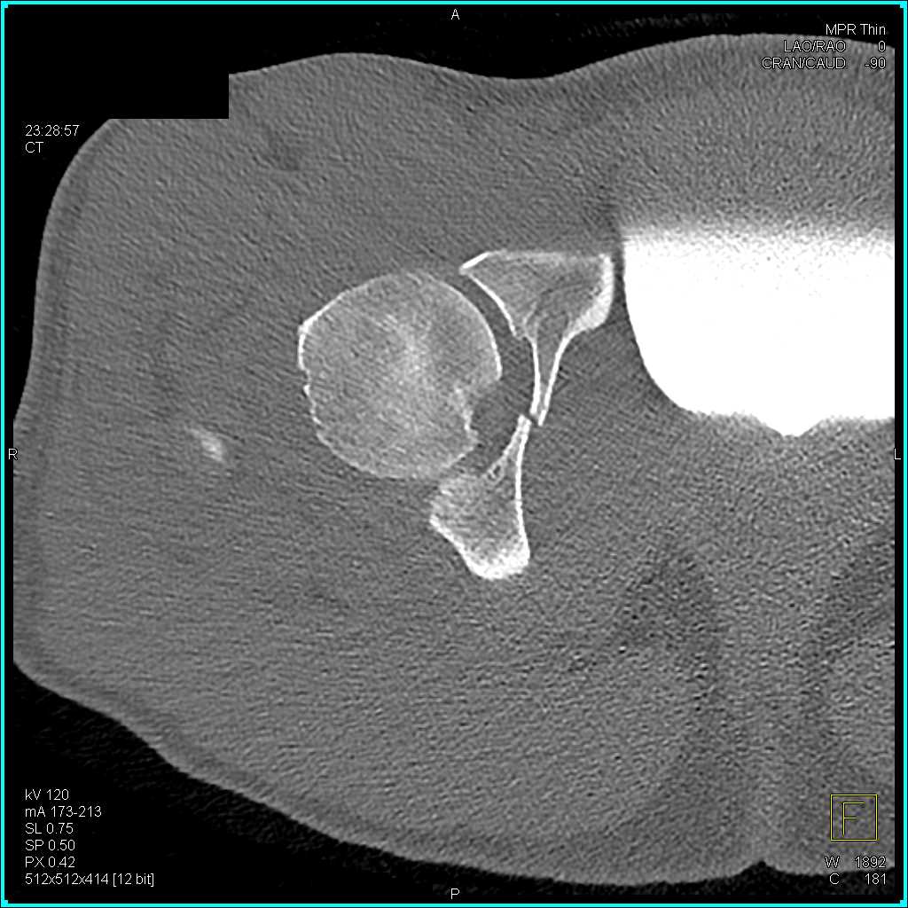 Fracture Acetabulum With Hematoma And Dislocation Musculoskeletal