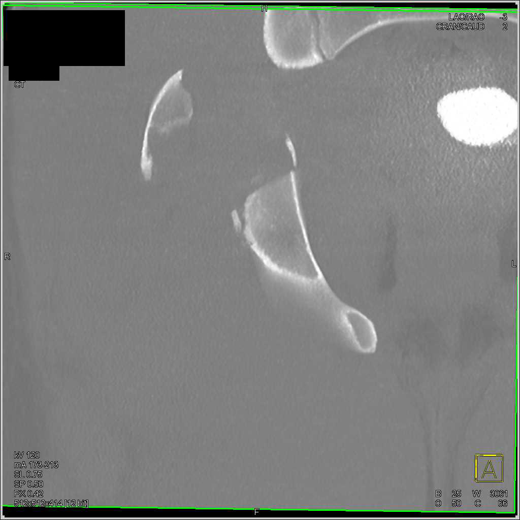 Fracture Acetabulum with Hematoma and Dislocation with Bone Fragment in the Hip Joint - CTisus CT Scan