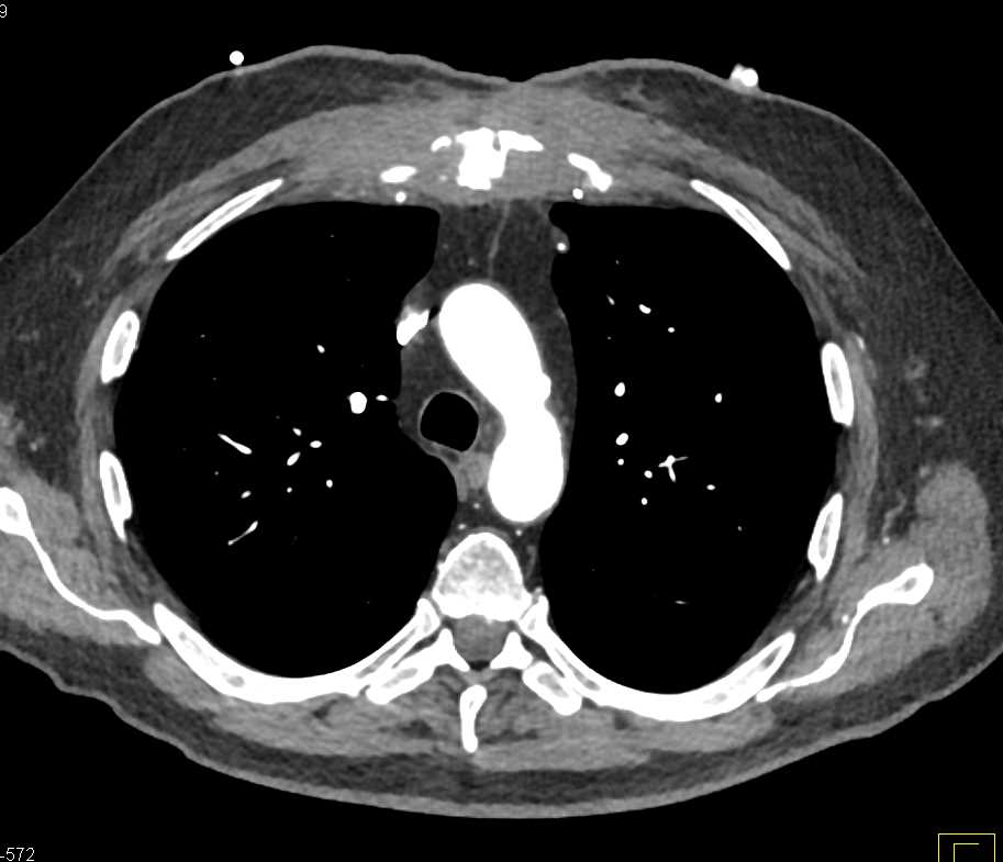 Sternal Osteomyelitis with Inflammation - CTisus CT Scan