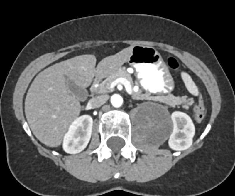 Schwannoma - CTisus CT Scan