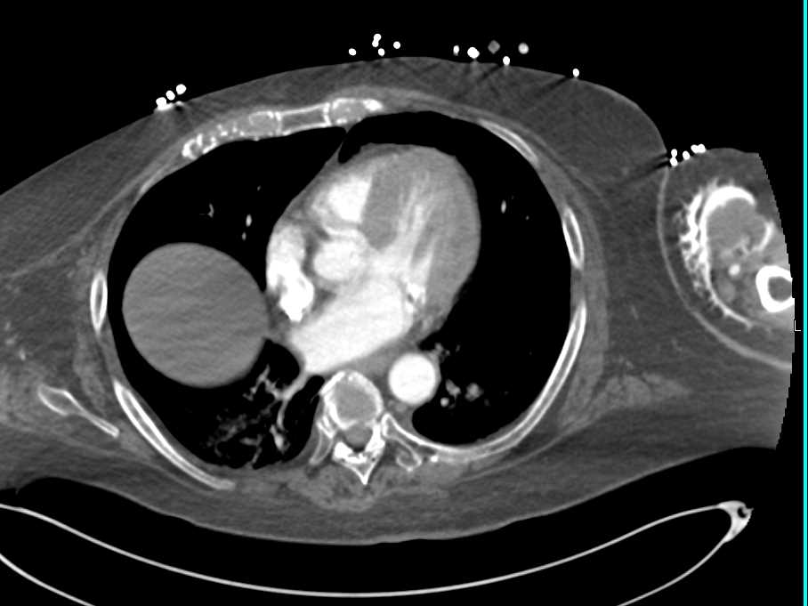 Extravasation Left Arm - CTisus CT Scan