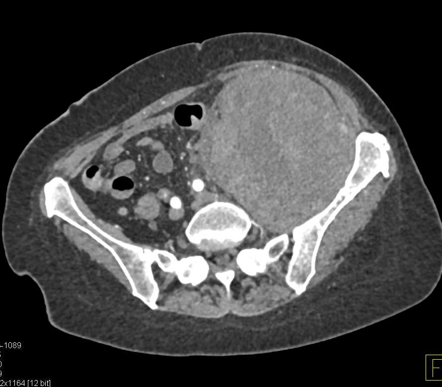 Liposarcoma Left Lower Quadrant - CTisus CT Scan