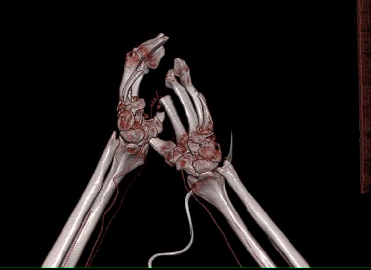 CTA for Planning of Hand Transplant - CTisus CT Scan