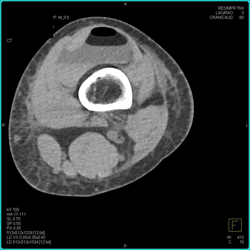 Tibial Plateau Fracture with Lipohemarthrosis - CTisus CT Scan