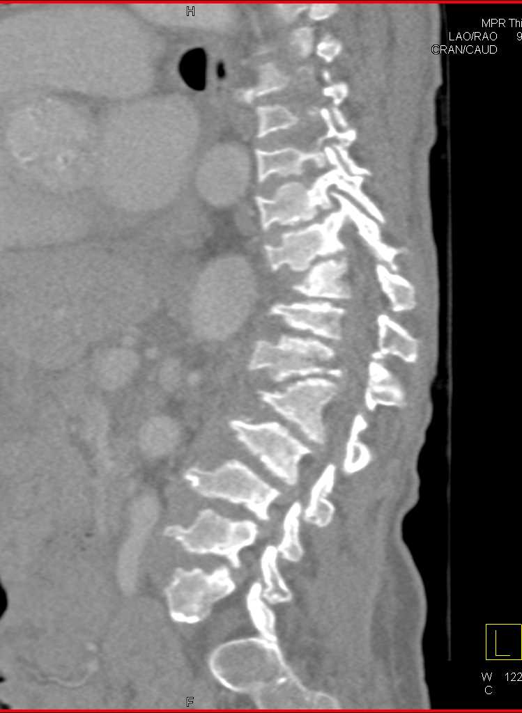 Morquio Syndrome (Type IV Mucopolyaccharidosis) - CTisus CT Scan