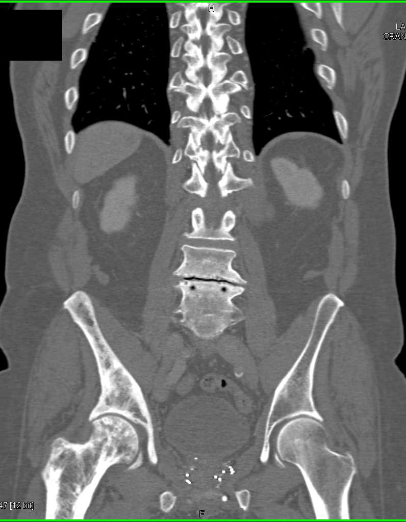 Paget's Disease Right Hemipelvis - CTisus CT Scan