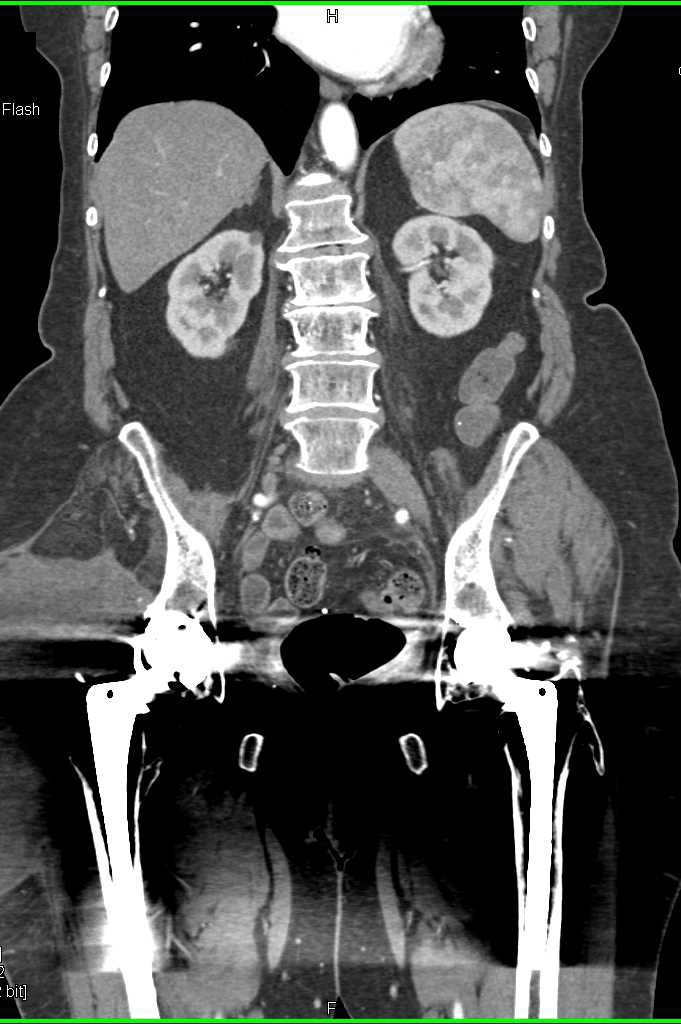 Artifacts from Bilateral Total Hip Replacements (THRs) - CTisus CT Scan