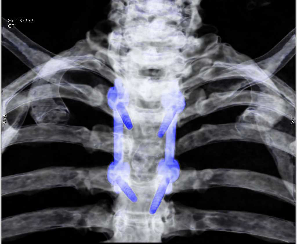 Hardware in the Spine - CTisus CT Scan