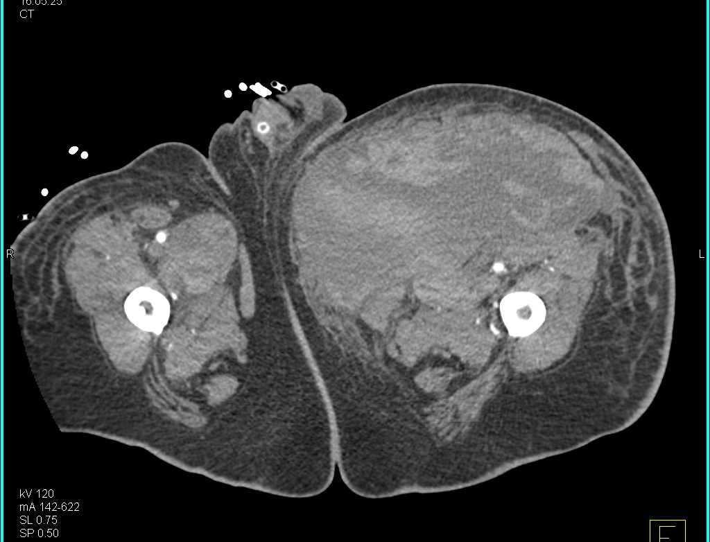 Bleed into the Left Anterior Thigh - CTisus CT Scan