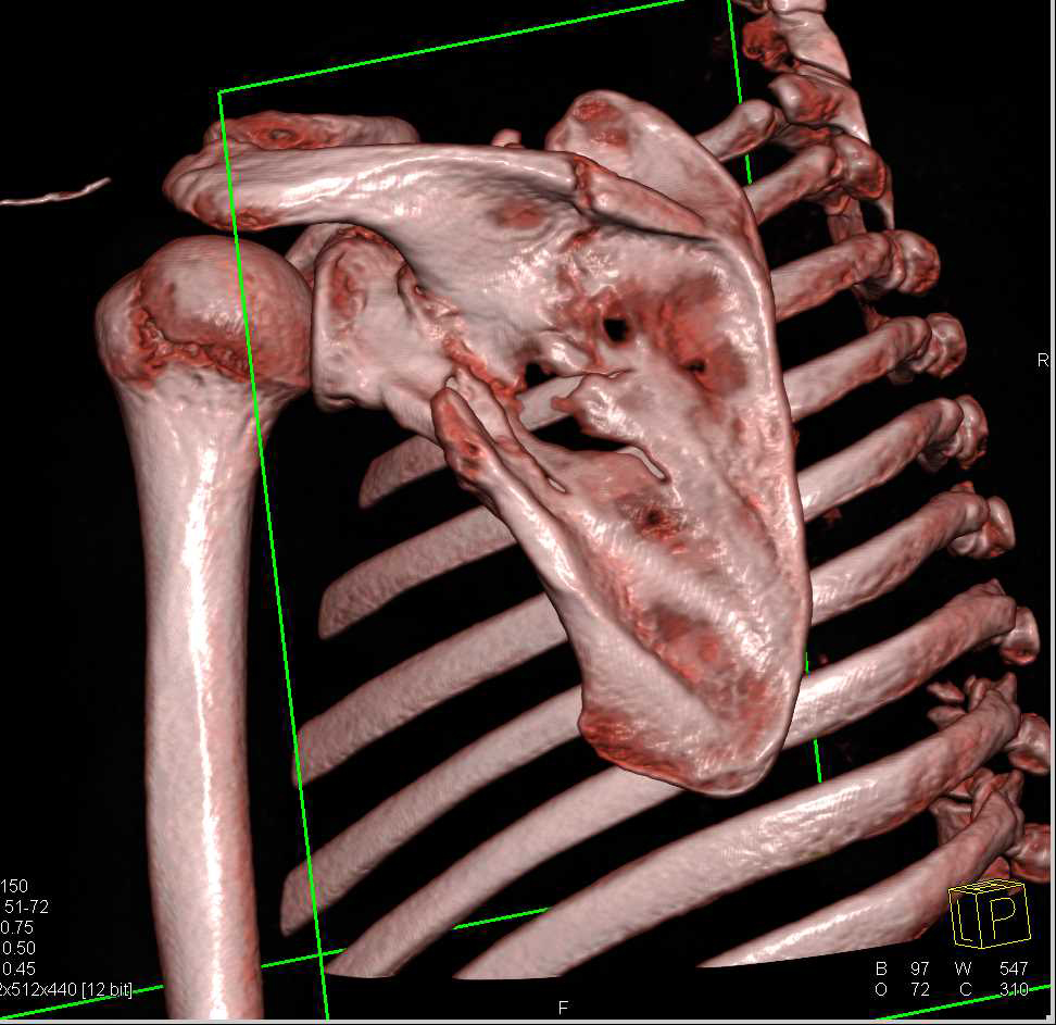 Scapular Fracture - CTisus CT Scan