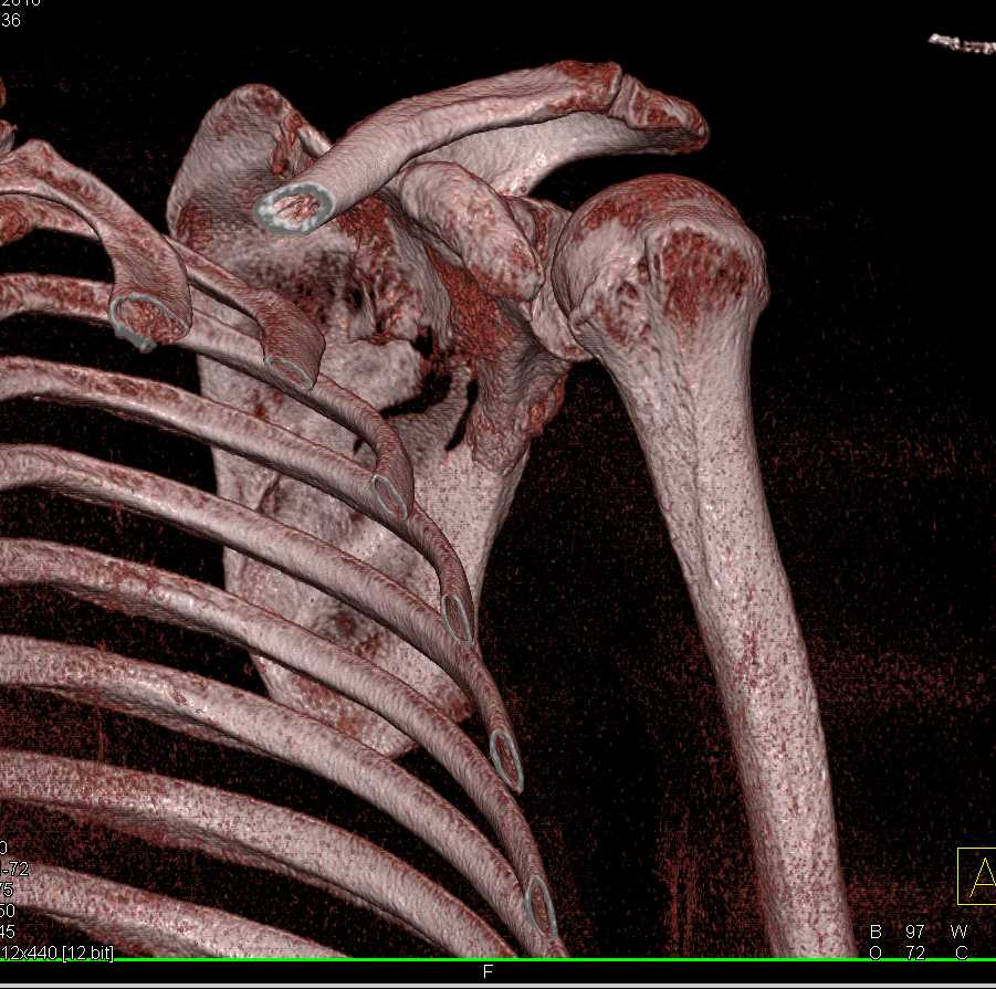 Scapular Fracture - CTisus CT Scan