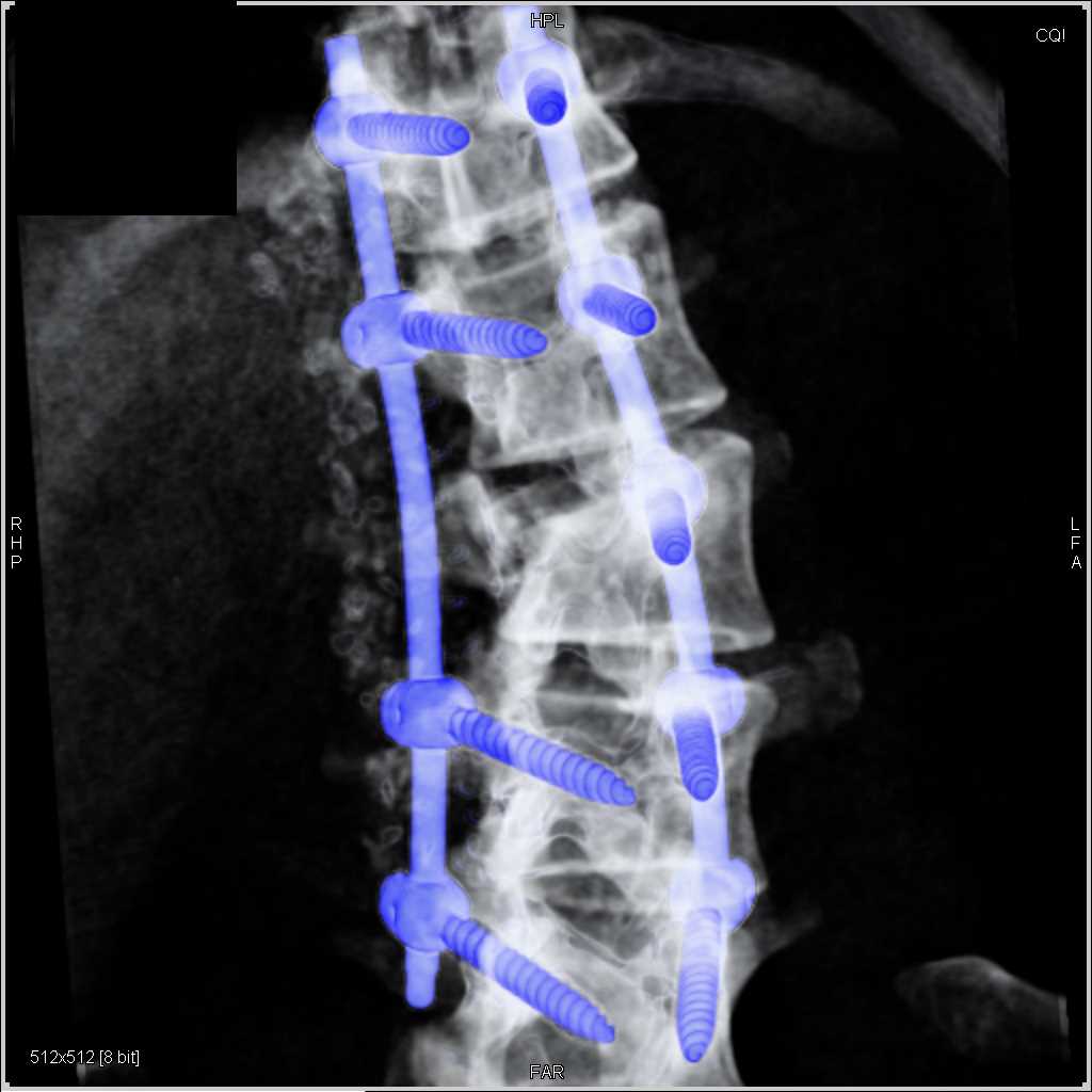 Hardware in the Spine - CTisus CT Scan