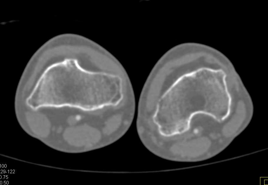 Hereditary Multiple Exostoses - CTisus CT Scan