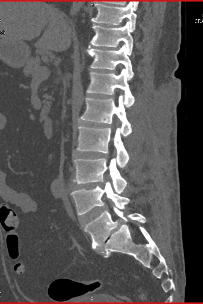 Discitis L3-4 best seen on sagittal views - CTisus CT Scan