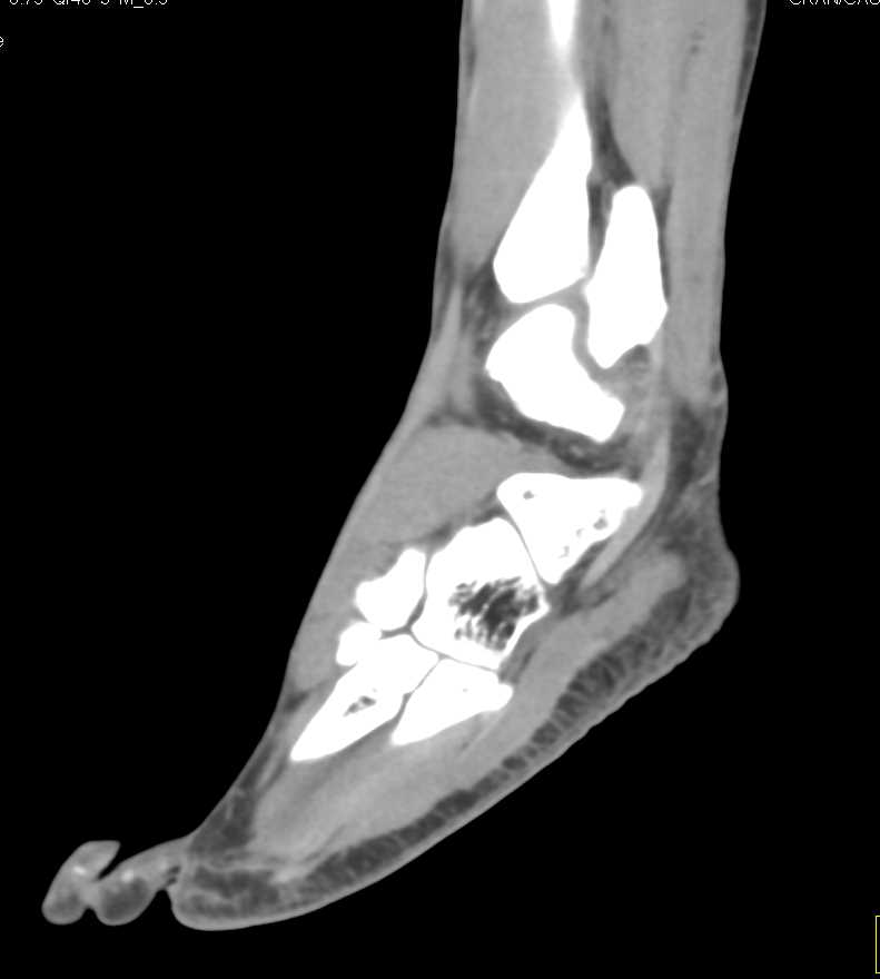 Gout on Dual Energy Study - CTisus CT Scan