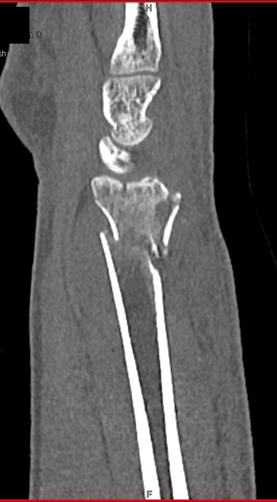 Distal Radius and Ulnar Fractures - CTisus CT Scan