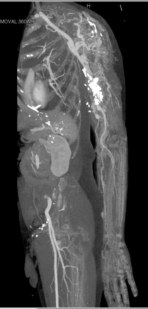 Arteriovenous Malformation (AVM) Left Shoulder - CTisus CT Scan