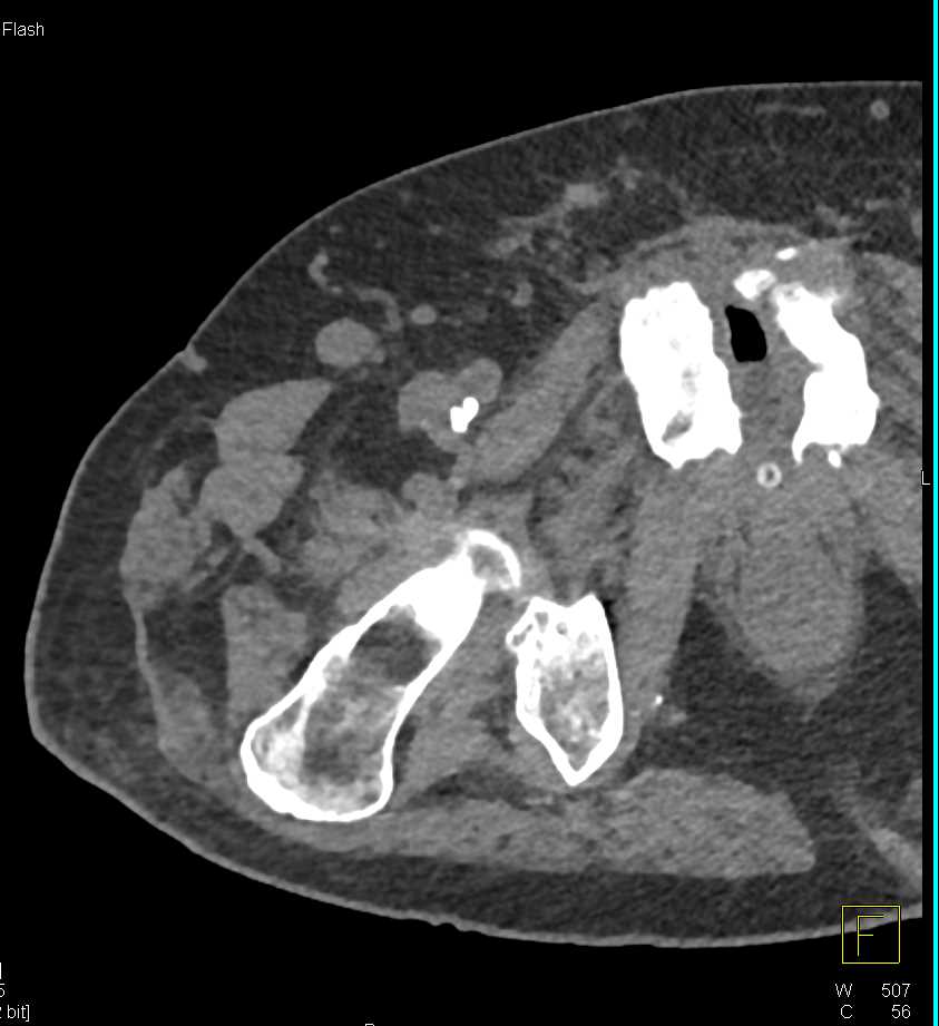 Osteomyelitis of the Symphysis and Local Infection - CTisus CT Scan