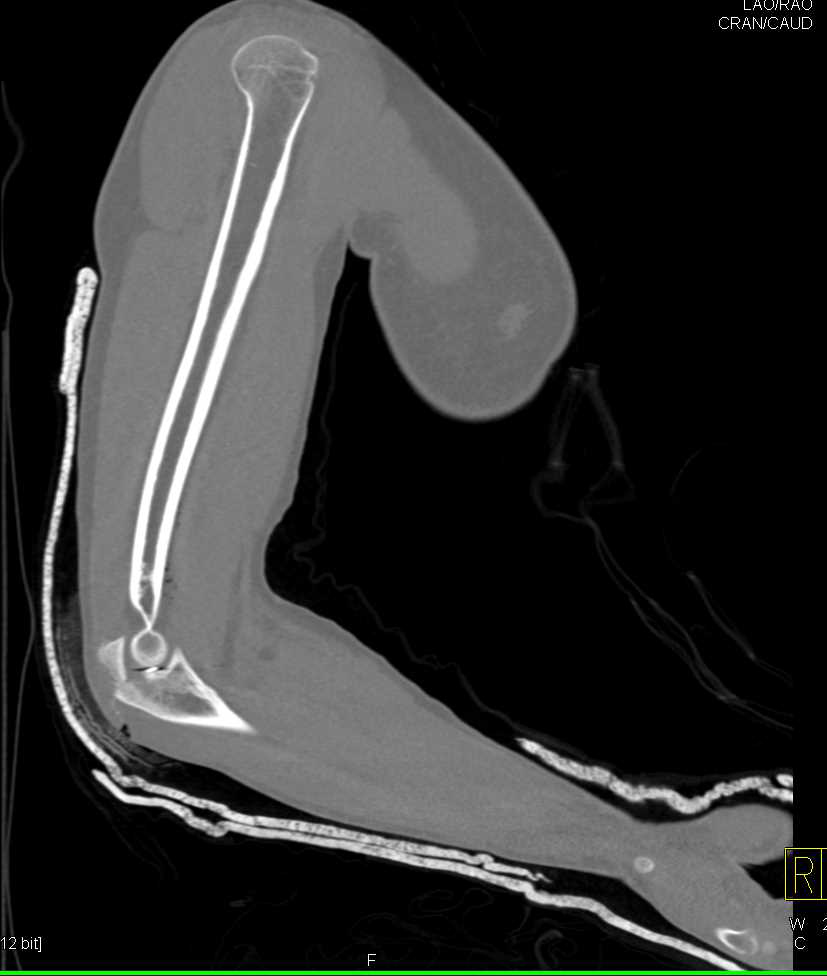 GSW with Fracture and Dislocation at the Elbow - CTisus CT Scan