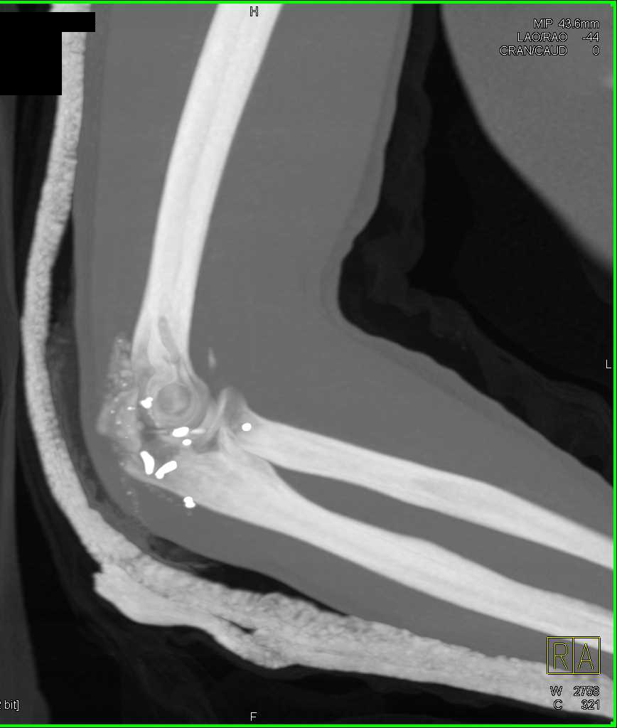 GSW with Fracture and Dislocation at the Elbow - CTisus CT Scan