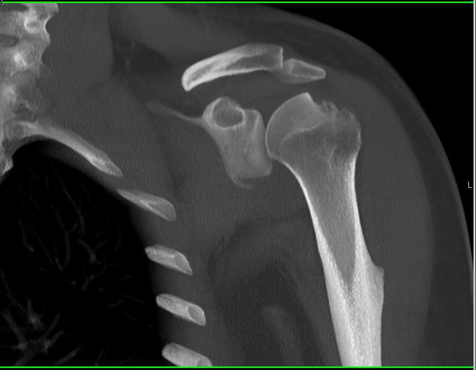 Sequelae of Fracture Dislocation of the Shoulder - CTisus CT Scan