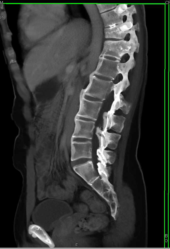 Fusion of the Sacroiliac Joints (SI Joints) and Bony Bridging Spine - CTisus CT Scan