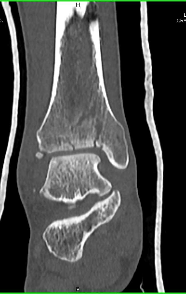 Distal Tibia and Fibular Fractures - CTisus CT Scan