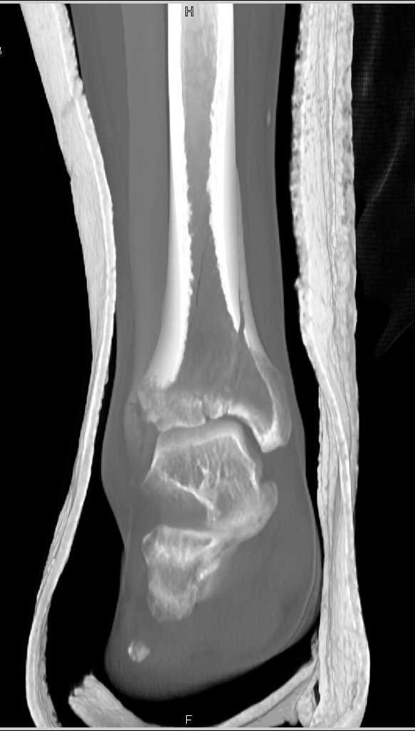 Distal Tibia and Fibular Fractures - CTisus CT Scan