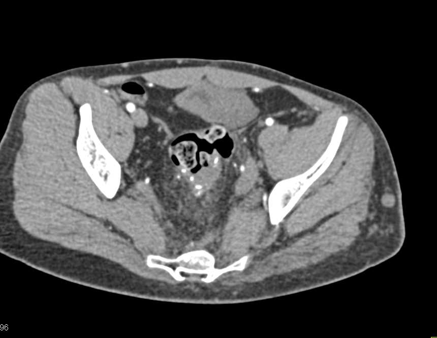 Varices in the Left Calf - CTisus CT Scan