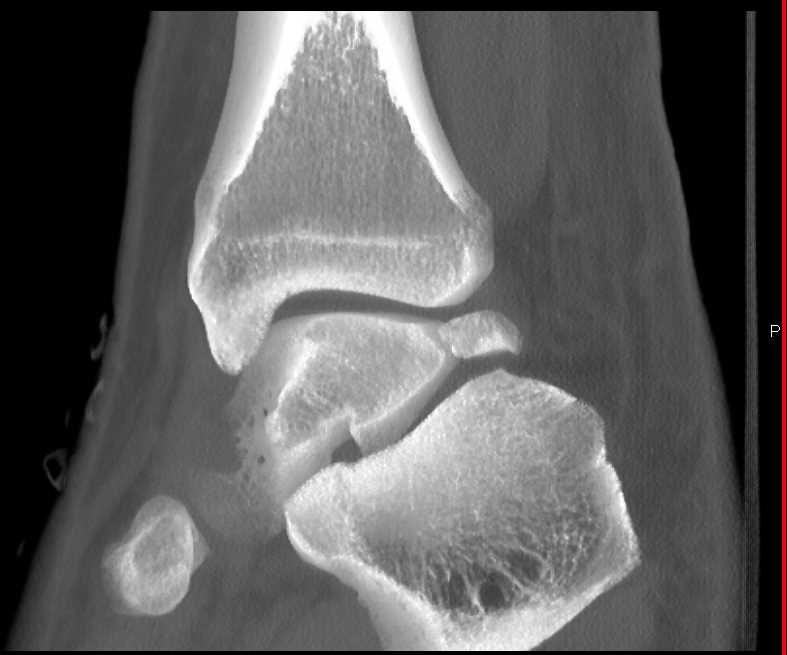 Prior Talus Fracture - CTisus CT Scan