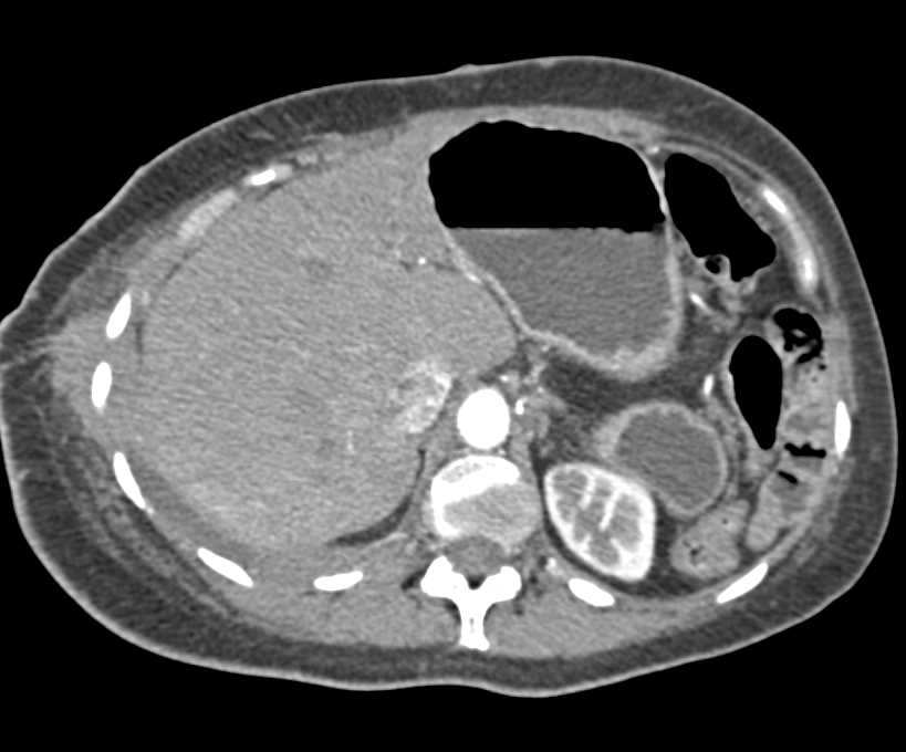 Tumor Recurrence Abdominal Wall at Biopsy Site - CTisus CT Scan