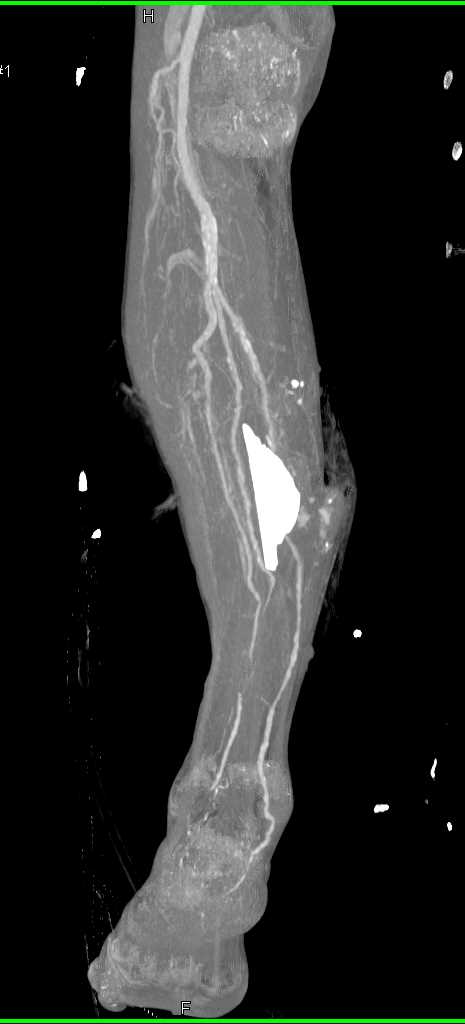 Comminuted Tibial Fracture with Vascular Injury - CTisus CT Scan