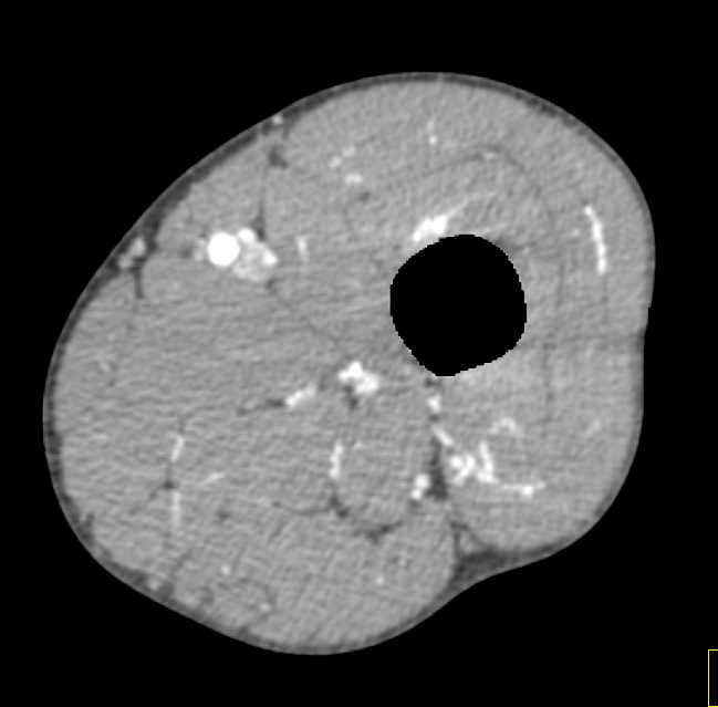 Comminuted Tibial Fracture with Vascular Injury - CTisus CT Scan