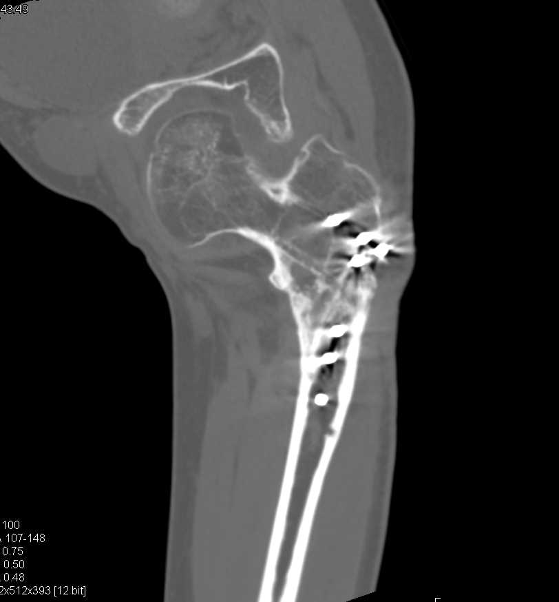 Osteogenesis Imperfecta - CTisus CT Scan